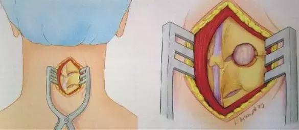 颈椎病曲度变直怎么治疗,低头族颈椎矫正的方法视频