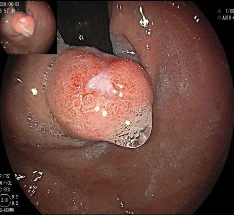 贲门隆起性病变影像,贲门溃疡隆起性病变