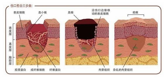伤口十几年不愈合,伤口几年不愈合不结痂