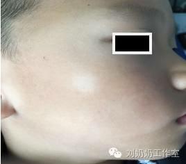 起白斑是什么原因,起白斑就是白癜风吗
