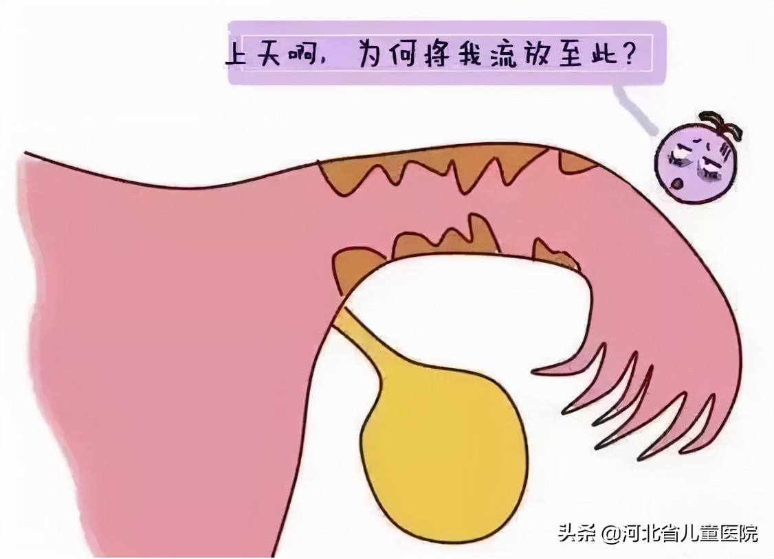 “迷路”的“受精卵”——警惕异位妊娠！