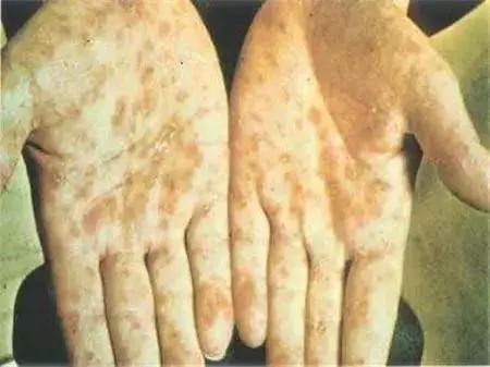 男子梅毒症状,男子被查梅毒后续