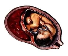 二胎妈妈大出血休克,二胎妈妈大出血