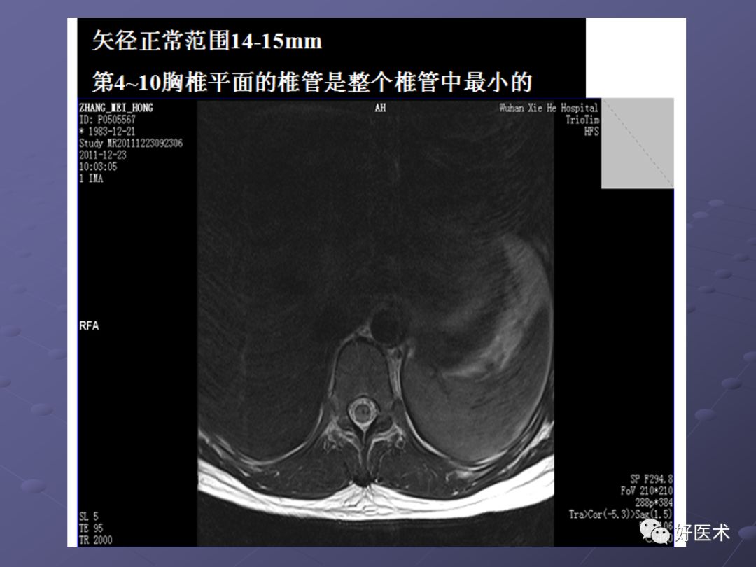 脊柱mri有哪些特点,乳腺疾病的mri诊断及鉴别
