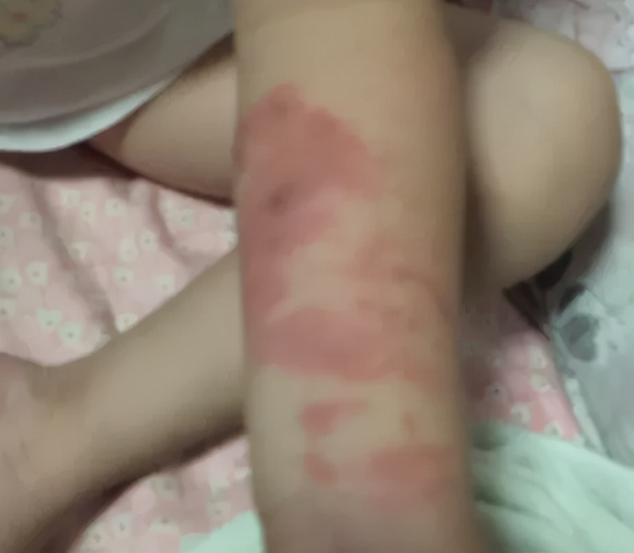 一岁宝宝被开水烫伤多久能好,不满一岁小孩被开水烫伤