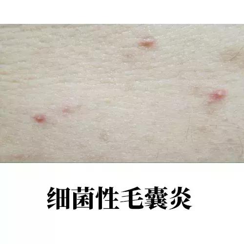 背上的青春痘,16岁背上长青春痘