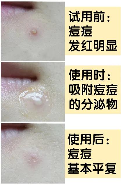 片仔癀净痘修护贴,抗痘贴片仔癀