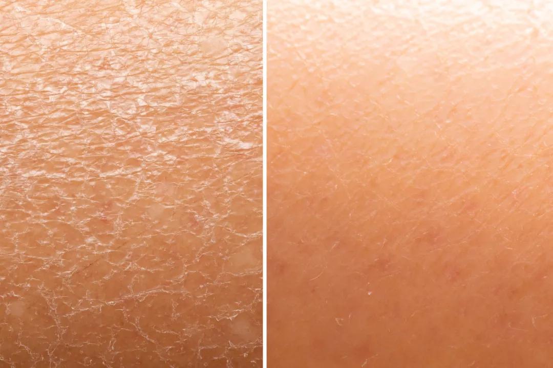 酒精伤肤烂脸,烂脸毁容怎么办