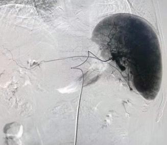 脾亢进介入治疗哪个医院好,宝宝脾功能亢进能治吗