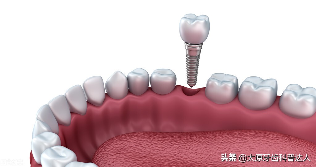 老年人可种植满口牙吗,老年人种植一颗大牙费用