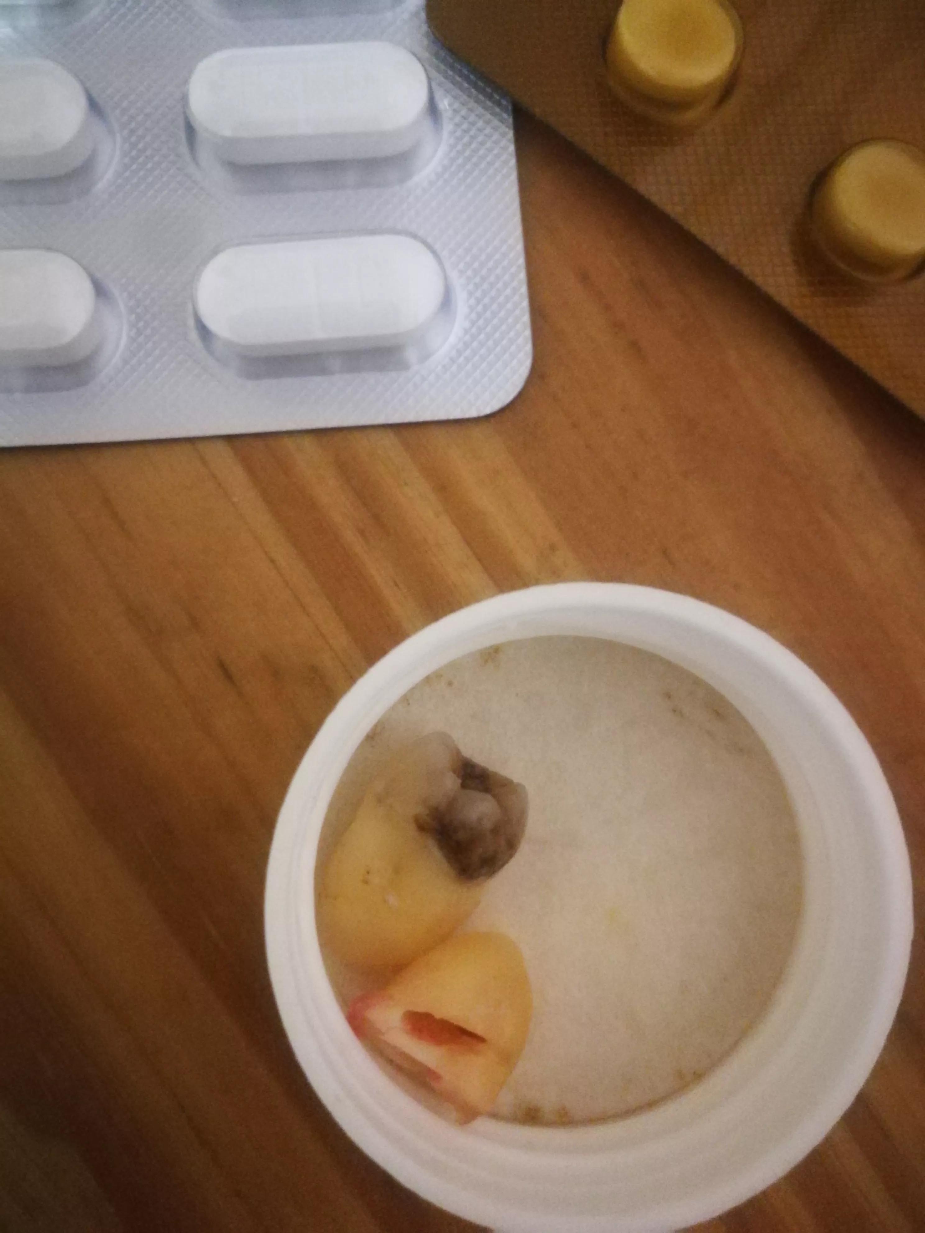 拔歪牙的过程,拔一颗长歪的牙