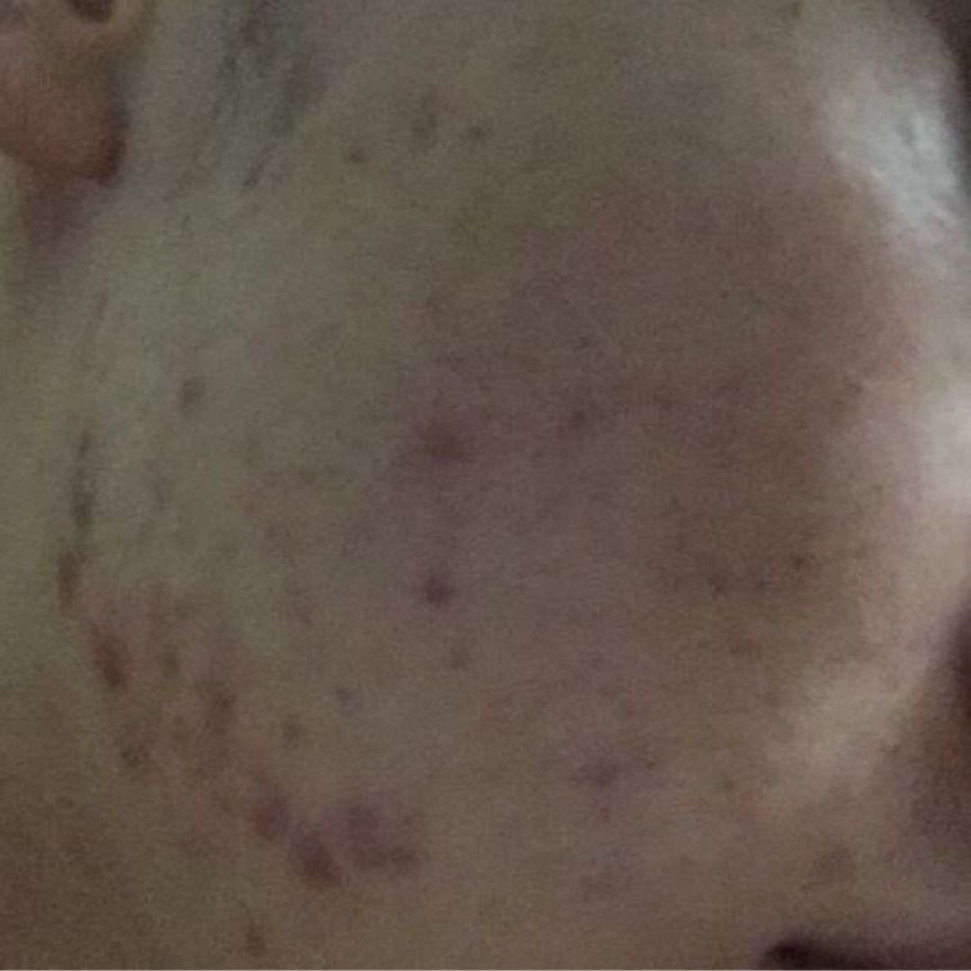 怎么祛痘祛痘印最有效的方法,如何快速祛痘祛痘印小妙招