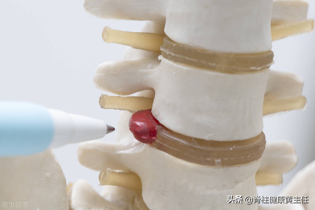 椎间盘突出介入治疗多长时间恢复,童国海介入法治疗腰椎间盘突出症