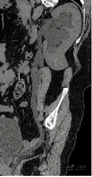 尿路梗阻导致肾积水不及时治疗,双肾积水是尿路梗阻吗