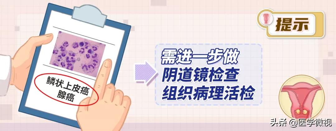 tct和hpv检查哪个确诊宫颈癌,宫颈癌tct检查是什么结果