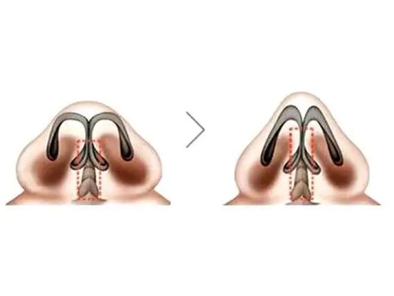鼻翼缩小和鼻头缩小需要全麻吗,鼻头缩小和鼻翼缩小有什么区别