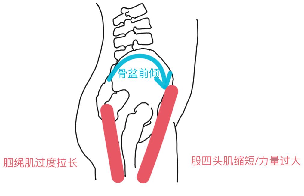 为啥大腿后侧拉伸很紧,大腿后侧筋拉伸导致疼痛能自愈吗