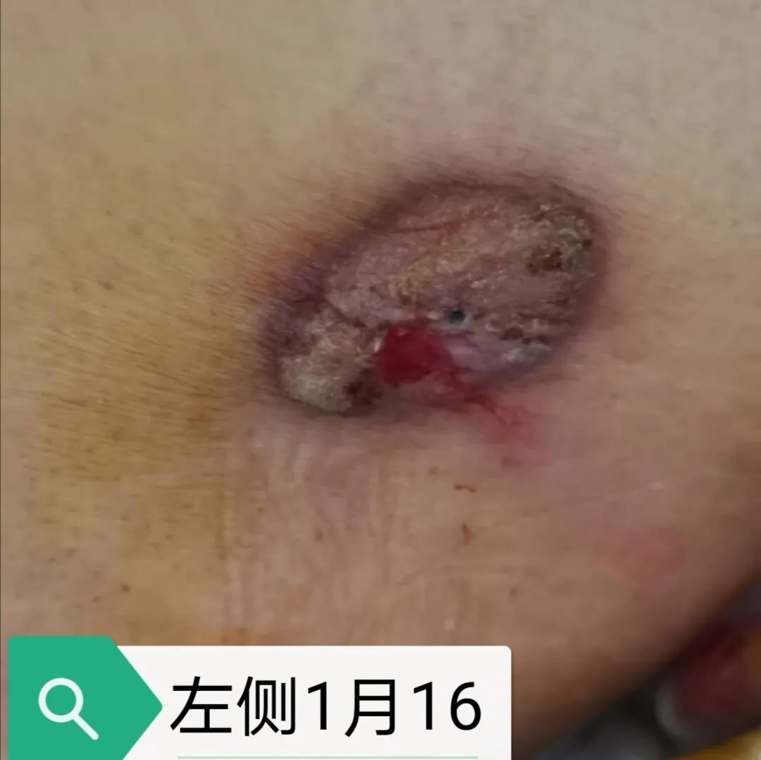 压疮的治疗成功和护理案例,压疮怎么护理好得快