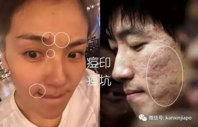 额头长闭口毛孔粗大爆痘怎么办,皮肤爆痘起闭口怎么回事