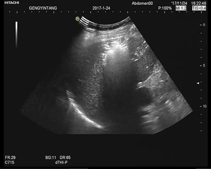 憩室炎怎么治疗效果最好,切口憩室有什么很好的治疗办法吗