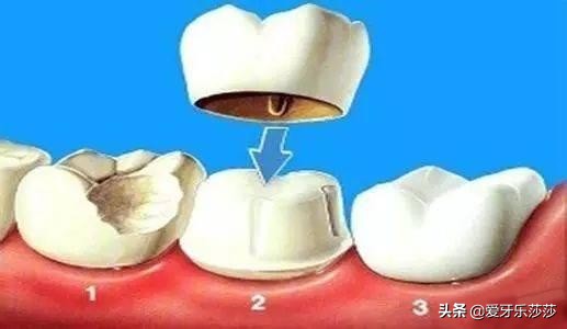 为啥做完根管治疗还有根尖炎,做全冠修复能不做根管吗