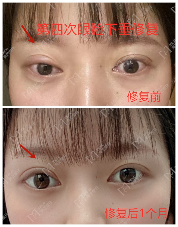 做双眼皮时判断出肌无力但未提肌,做双眼皮说是眼睛肌力不够