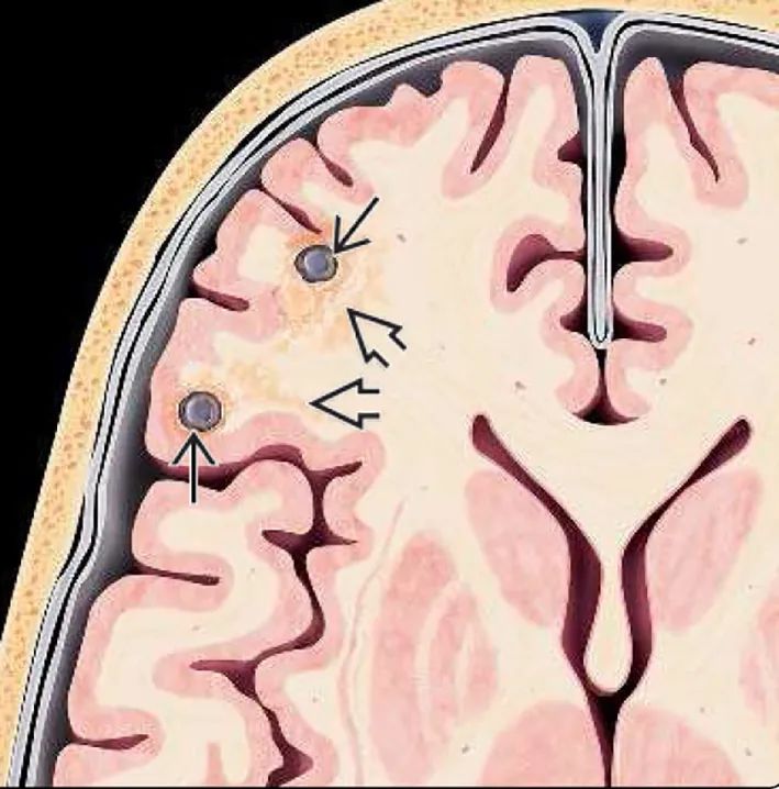 脑子里有4毫米的瘤,脑子里为什么会长瘤