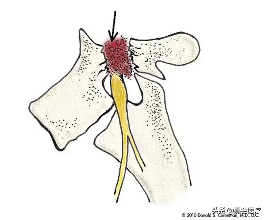 腰椎椎弓崩裂是什么原因造成的,腰痛是犯了什么因果