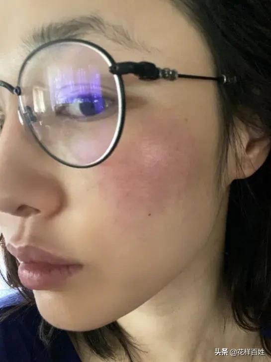 皮肤被晒脱皮了如何修复,皮肤脱皮泛红用什么修复