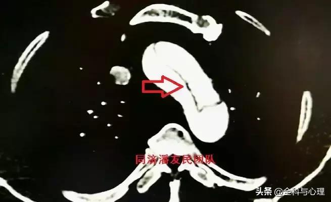 诊断主动脉夹层，千万别犯这种错误！