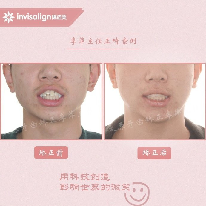 二甲医院骨性前突龅牙矫正多少钱,太原骨性嘴凸矫正牙齿图片