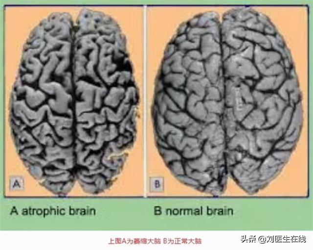 老年人体检出来脑萎缩,脑白质稀疏脑萎缩是老年痴呆吗
