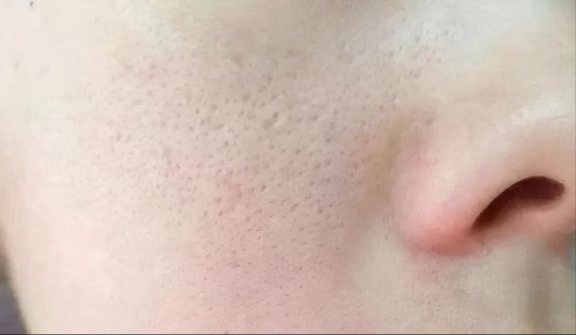 解决肌肤毛孔粗大有效方法,怎么解决皮肤毛孔粗大