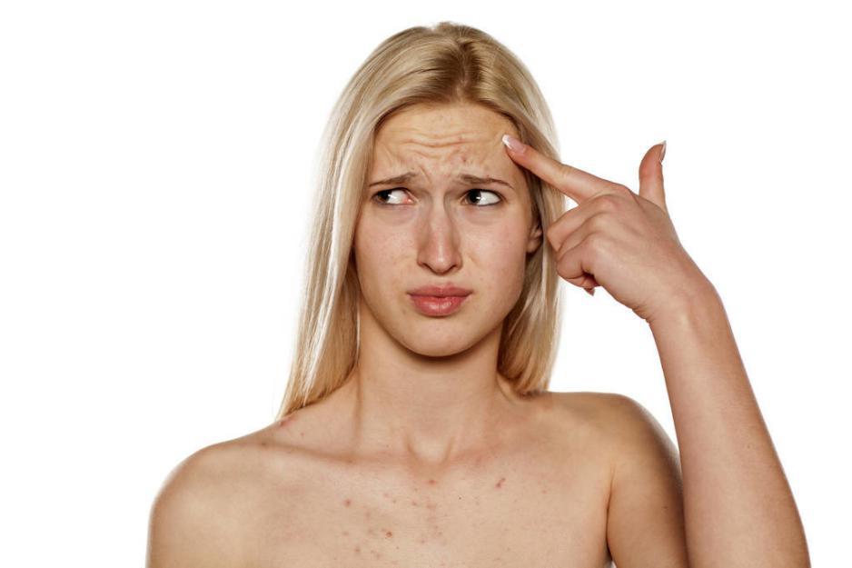 最全面最安全的祛痘小窍门,逆天祛痘的方法