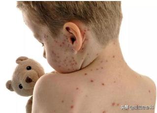 宝宝长水痘怎么处理好得快,小孩子水痘要是没发好会怎么样