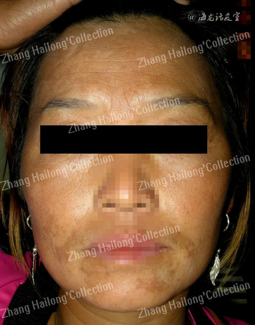 褐斑治疗,褐斑怎么办