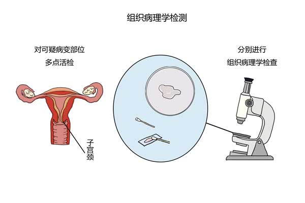 宫颈癌发病率与地域有关系吗,宫颈癌到底有多严峻