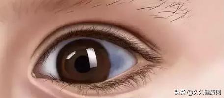 眼白上有黄斑会有什么后果,眼白有黑点是中邪了么