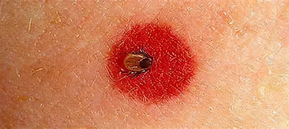 当心！假期出游警惕身体出现这样的小红点，严重或可致命