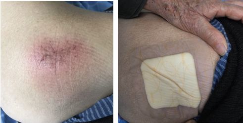 压疮敷料的选择及使用,褥疮敷料的正确使用方法