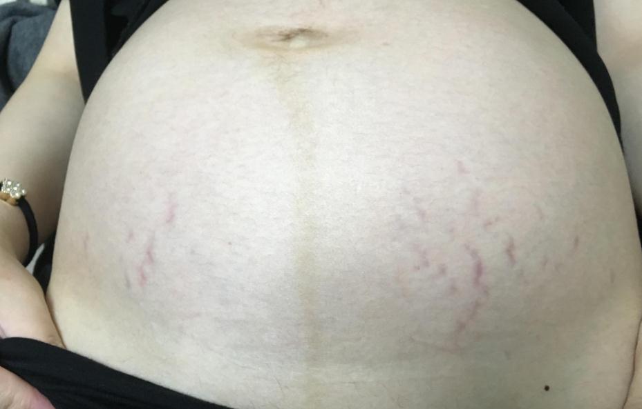 为什么孕妇有的肚脐凸出有的凹,为什么孕妇肚脐是个坑