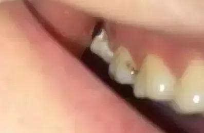 那些不拔智齿的人后来都怎么样了,那些该拔不拔的智齿最后都咋样了