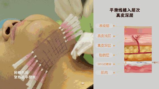 线雕吸收完了脸会变窄吗,做一次线雕代谢后会不会回到以前