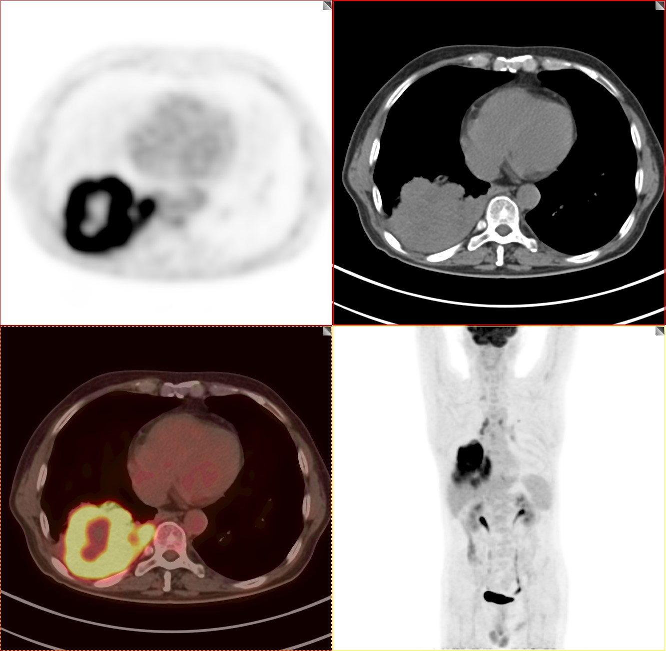 petct肺癌晚期必须要做吗,肺癌患者petct