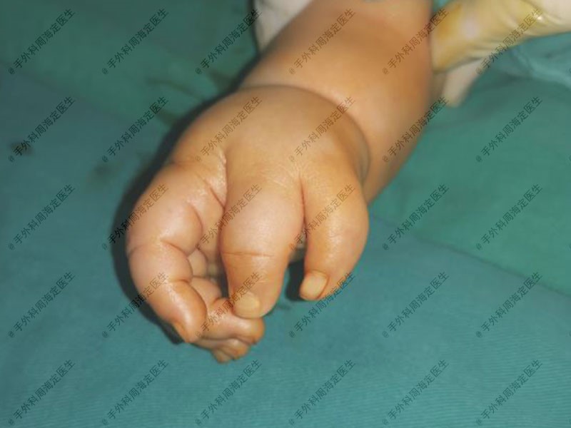 宝宝一出生手就比较大,宝宝一出生手掌就比别的宝宝大