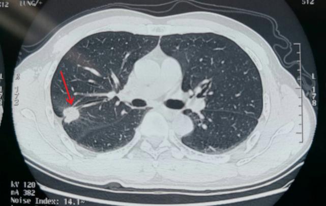 肺癌！已经发了CT诊断报告，还有必要做穿刺？不算重复吗？