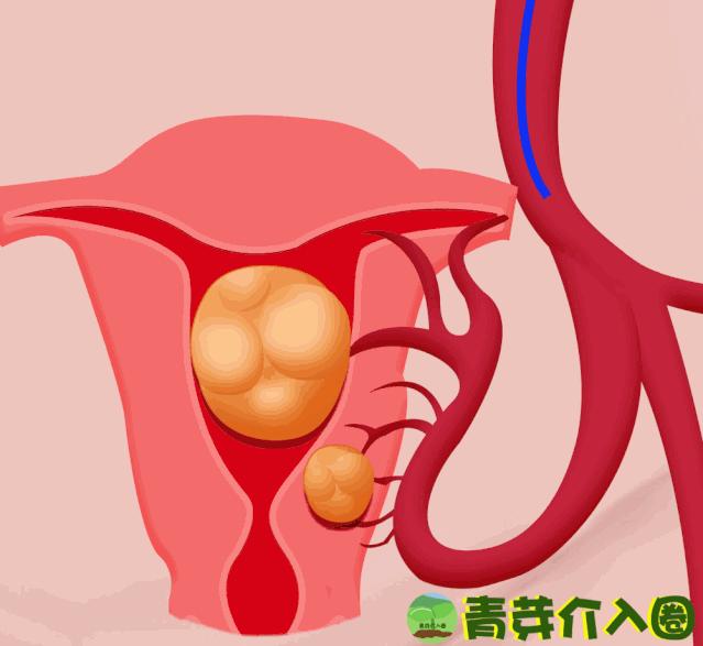 子宫肌瘤介入术动画,子宫肌瘤介入治疗动画演示