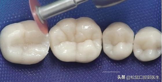 补牙齿补上的会掉吗,补的牙齿老是掉