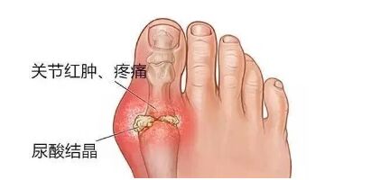 尿酸高引起的痛风只有大脚趾疼么,尿酸高痛风2次了要吃药吗