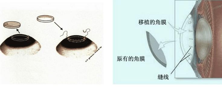 糖皮质激素在内科疾病中的应用,糖皮质激素在眼科的应用